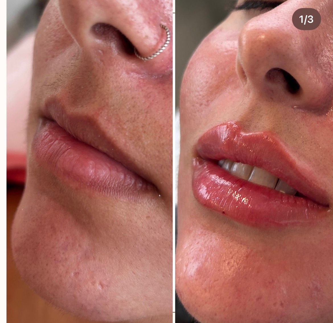 Resultado preenchimento labial